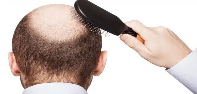 أفضل علاج لتساقط الشعر من الصيدلية