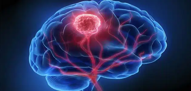 هل ورم المخ يؤدي إلى الوفاة